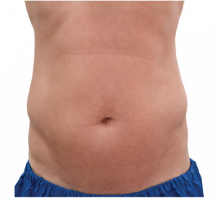 body-treat-2-bfr