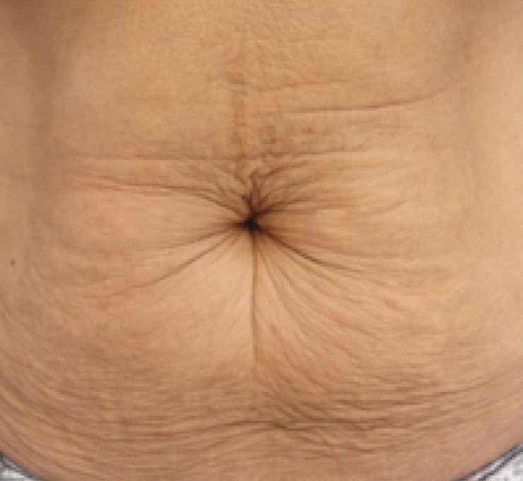 body-treat-3-bfr