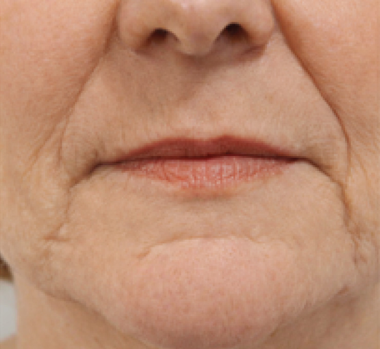 derma-10-bfr