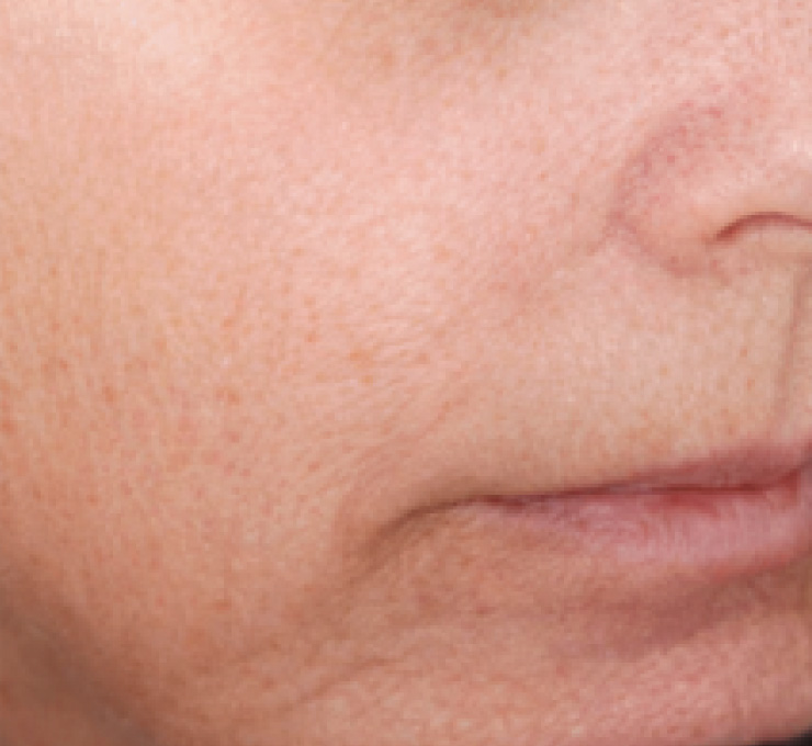 derma-12-aft