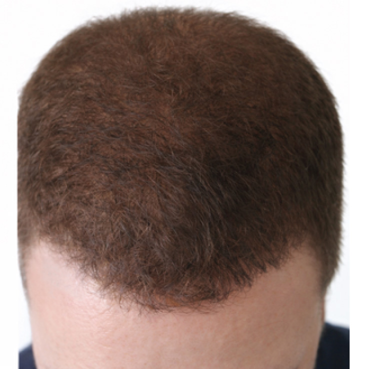 hair-treatment-1-aft