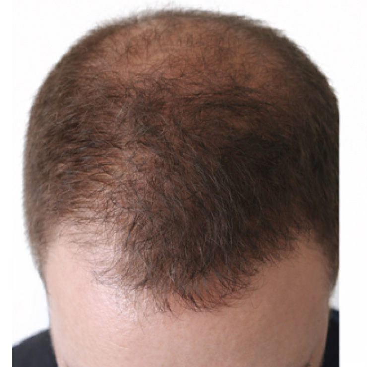 hair-treatment-1-bfr