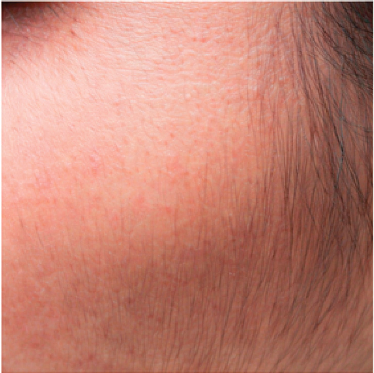 hair-treatment-4-bfr